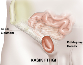 Kasık Fıtığı