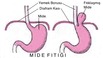 mide fıtığı