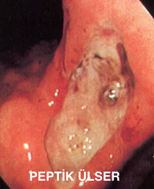 peptik ülser
